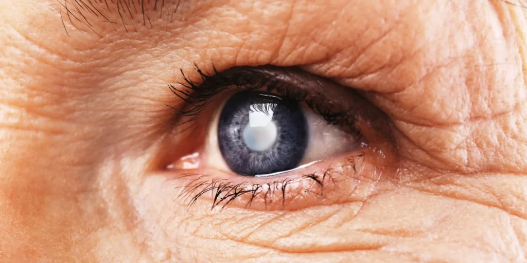 grauer star op wie lange krank